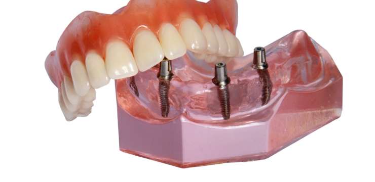 dentalcom-protesi