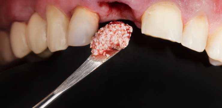 dentalcom-chirurgia-ossea